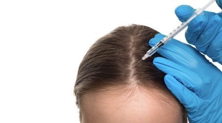 Een vrouw die een haartransplantatie ondergaat