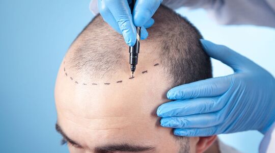 Haartransplantatie-01